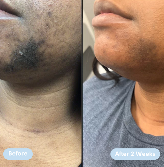 High Roller Ingrown Hair Tonic